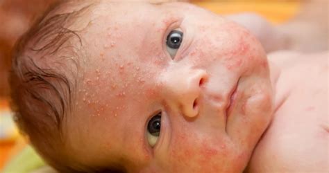 Baby Acne - Causes, Symptoms and Treatment of Baby Acne