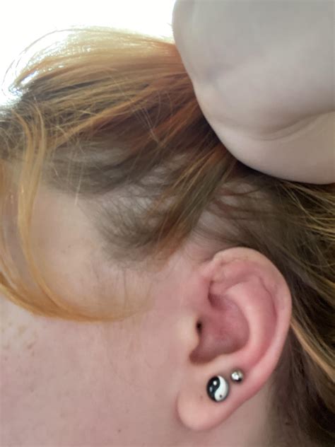I have a hard pimple or cyst in my earlobe, would it go away over time