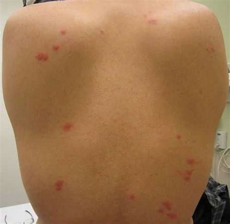 Rimedi per la Cimice dei letti