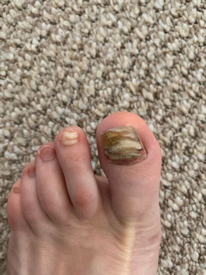 Green Nail Pseudomonas Infection | Fungal Laser Nail Surgery Specialist ...