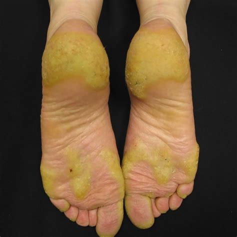 Hyperkeratosis Feet