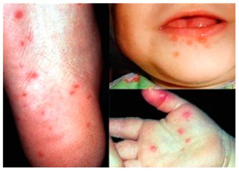 Development of Novel Vaccines against Enterovirus-71