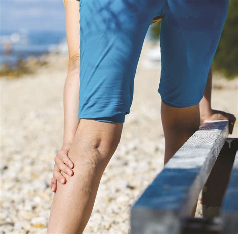Why varicose veins are more than just a cosmetic concern - Vero News