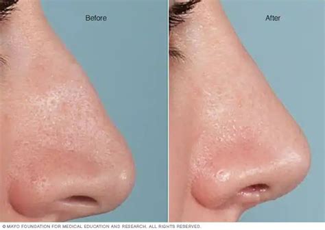 rhinoplasty nose surgery fort hospitals