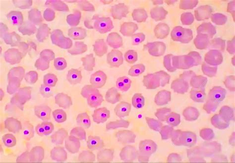 malaria parasite pv plasmodium vivex blood smear microscopic  image