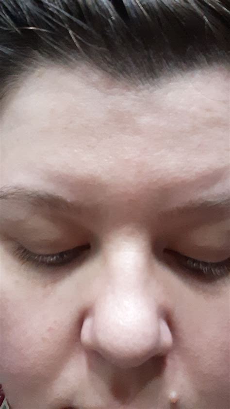 puffy above eyebrows. burning forehead no pain : r/DiagnoseMe