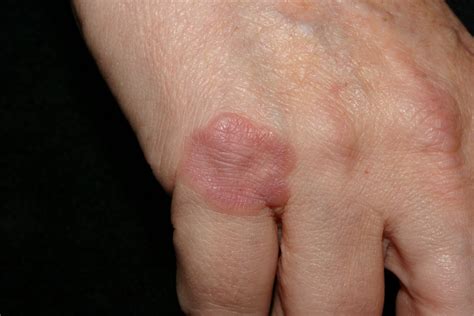 Granuloma Annulare - Causes, Rash, Treatment