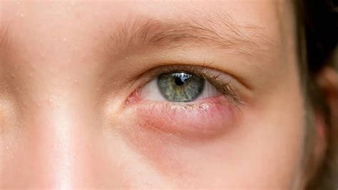 Como Desinflamar O Olho Rápido - Cómo desinflamar los ojos rápidamente: tips y consejos