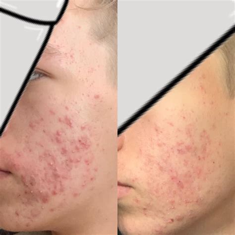 2 Weeks on 10 mg Celexa — Side Effects & Efficiency : r/citalopram_celexa