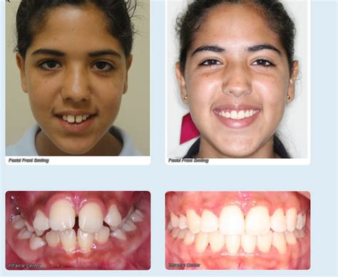 severe overbite    braces