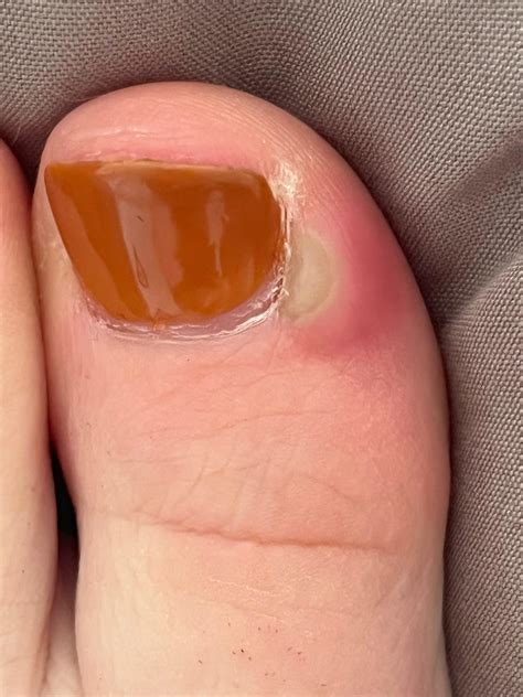 Is this a toe infection? Happened right after getting a pedicure. It ...