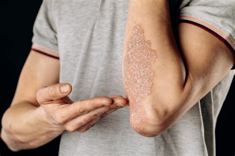premium photo acute psoriasis   elbows   autoimmune