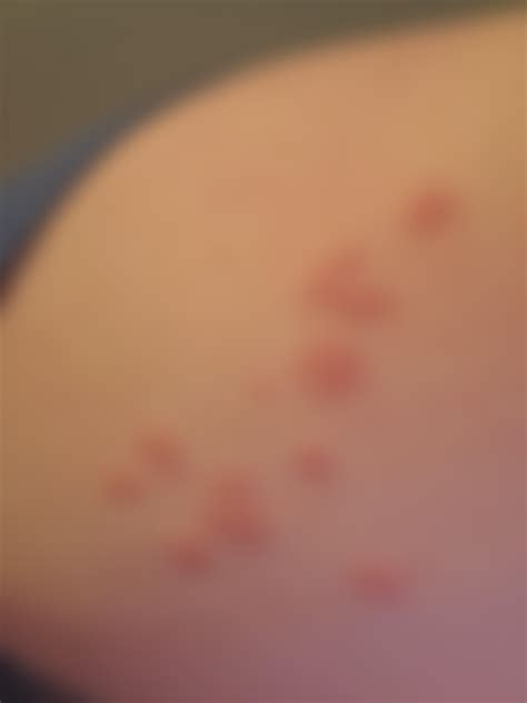 What is this?? It only itches rarely (usually if im sweating) its only