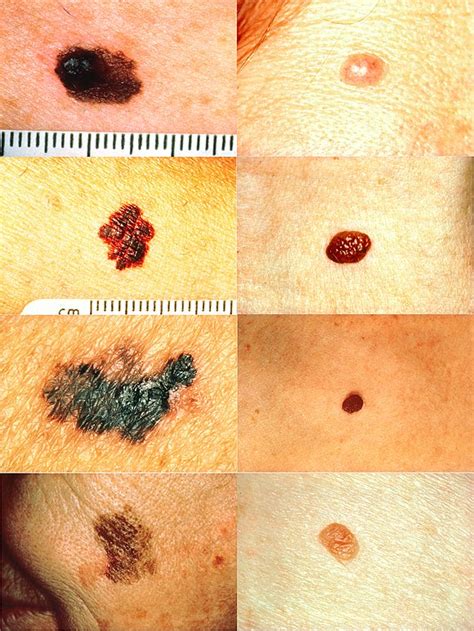 melanoma wikipedia
