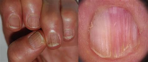 Brittle Nails Onychoschizia And Onychorrhexis - Nail Ftempo