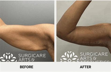 Where Are the Arm Lift Scars Placed and How to Get Rid of Them?