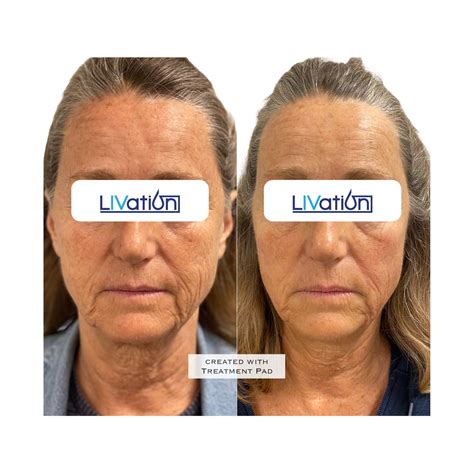 mini face lift cost near me 6