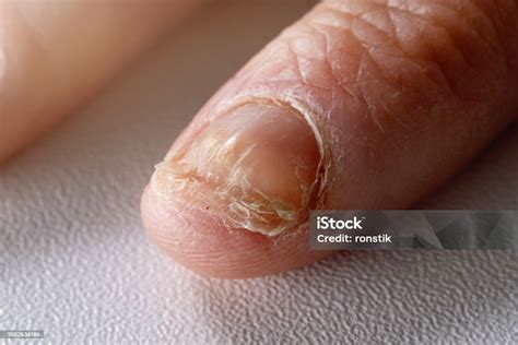 fungal infection nail fungus candida  hand fingernail stock photo