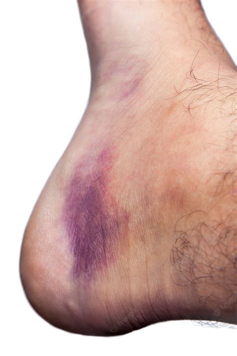 Bruised Ankles – Free Clipart #3581220 | Clipart Library