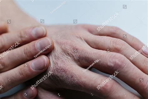 Man with sick hands, dry flaky skin on his hand with vulgar psoriasis, eczema and other skin ...