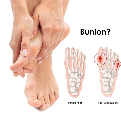 Bunion Correction: Effective Treatments for Bunion Relief - Stat Podiatry