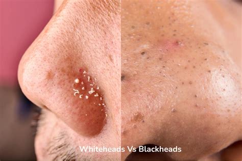 whiteheads removal effective treatment  eliminate pimple