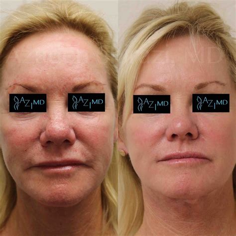 Halo - La Jolla Dermatology