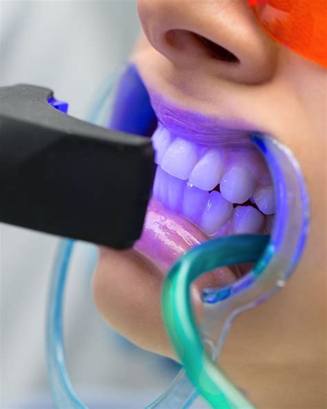 What Foods Can You Eat After Whitening Your Teeth? | Sarah Scoop