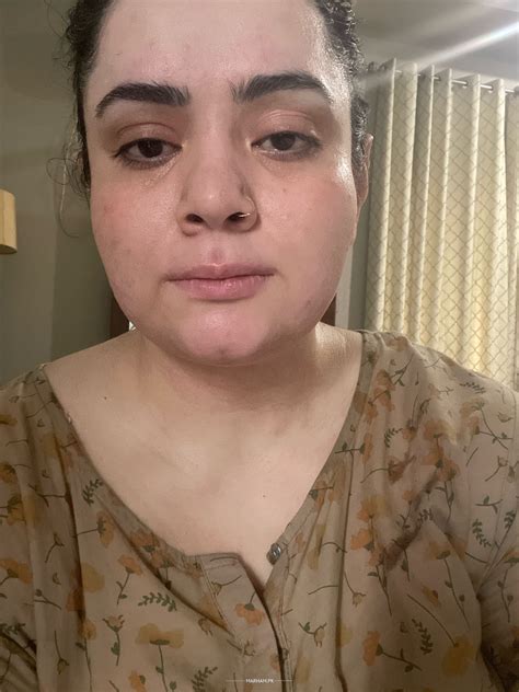 what causes under eye bags 7