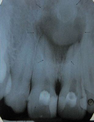 The case of a Nasopalatine duct cyst Vs. a Radicular cyst - BMJ Case ...