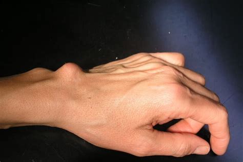 kyste synovial du poignet maladie du poignet pr eric roulot