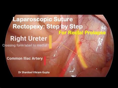 laparoscopic suture rectopexy  rectal prolapse  alternative