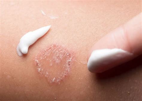 O Que Causa Micose Na Pele - Micose: o que é, causas, sintomas, prevenção e tratamento