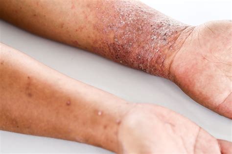 Inadequately controlled atopic dermatitis