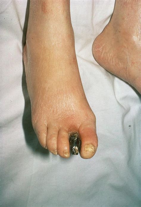 Gangrenous Toe In Diabetes Photograph by St Bartholomew Hospital ...