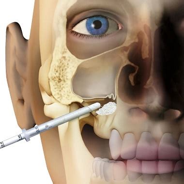 Open and closed sinus lifting: what is it and what is the difference ...
