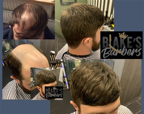 Male Pattern Baldness Treatments – What’s Available? - Barber Banter Shop