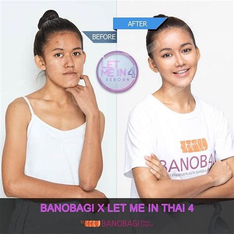 BANOBAGI PLASTIC SURGERY (@banobagi_english) • Instagram photos and ...