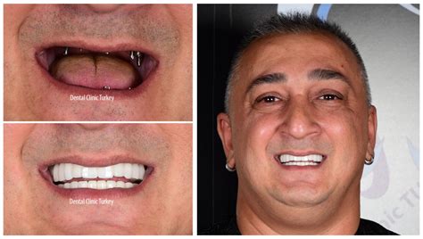 All on 6 Dental Implant Procedure in Turkey, Cost, Advantages