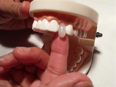 temporary tooth video  evelyn gentle blog