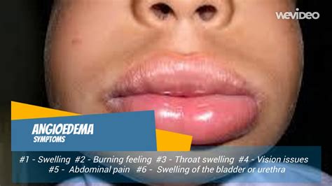 SYMPTOMS of angioedema - YouTube