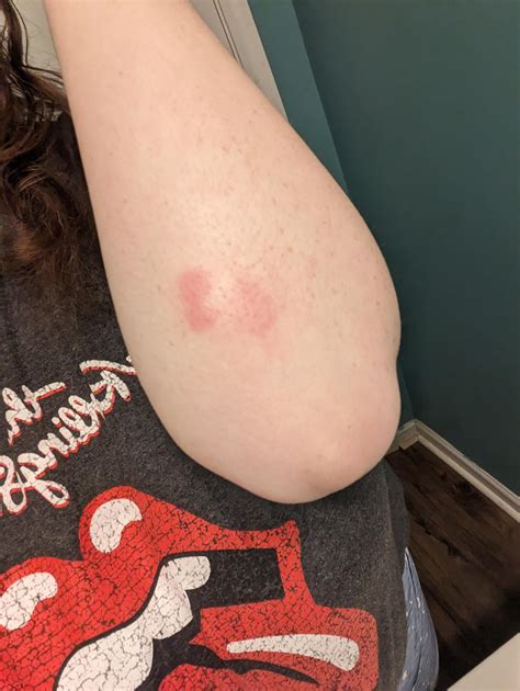 possible allergic reaction? : r/medical_advice