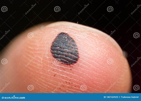 finger pad hematoma  krystal terry blog