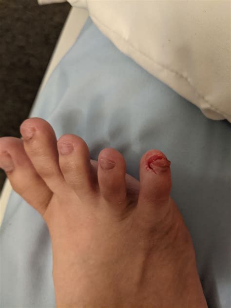 Stubbed my toe at an angle on a beam and ripped my nail off backwards
