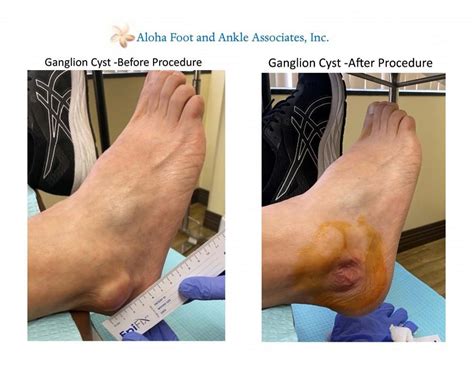 ganglion cysts  feet ganglion cyst  foot pictures