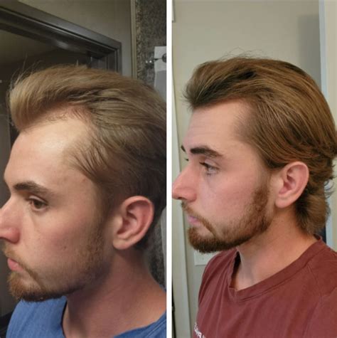 minoxidil        work