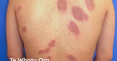 Discoid eczema image