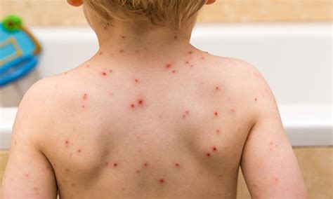 Chickenpox | NHS inform