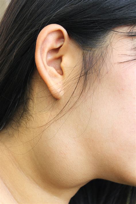 Tumors, Growths, and Lumps of the Head and Neck Areas DoctorLansford.com