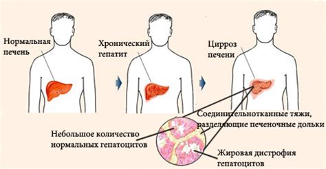 Алкогольний цироз печінки